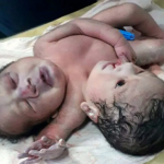 At viewers discretion: Woman gives birth to ‘rare conjoined twins’ with two heads, three arms and shared organs