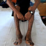 Kogi records 20 new cases of leprosy